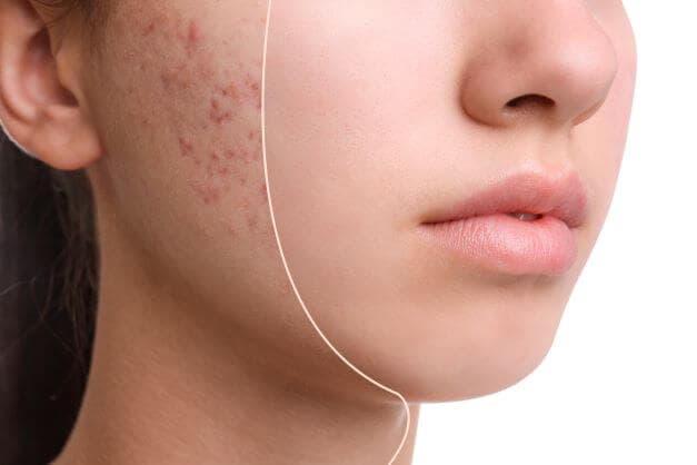 Protocol: Clearing the way Valeo Guide to Managing Acne