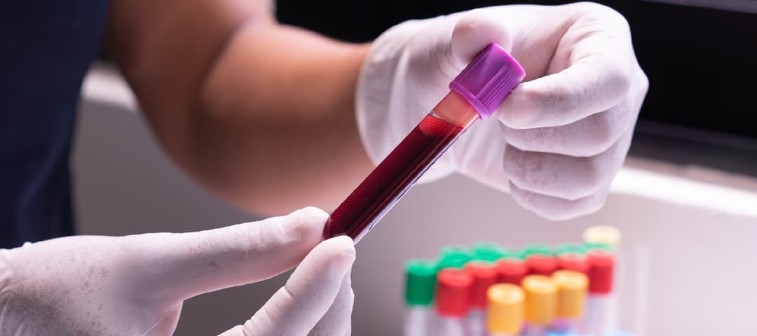 Lipid Profile Test in Dubai: What You Need to Know (2025 Guide)
