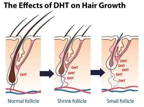What Finastride does?