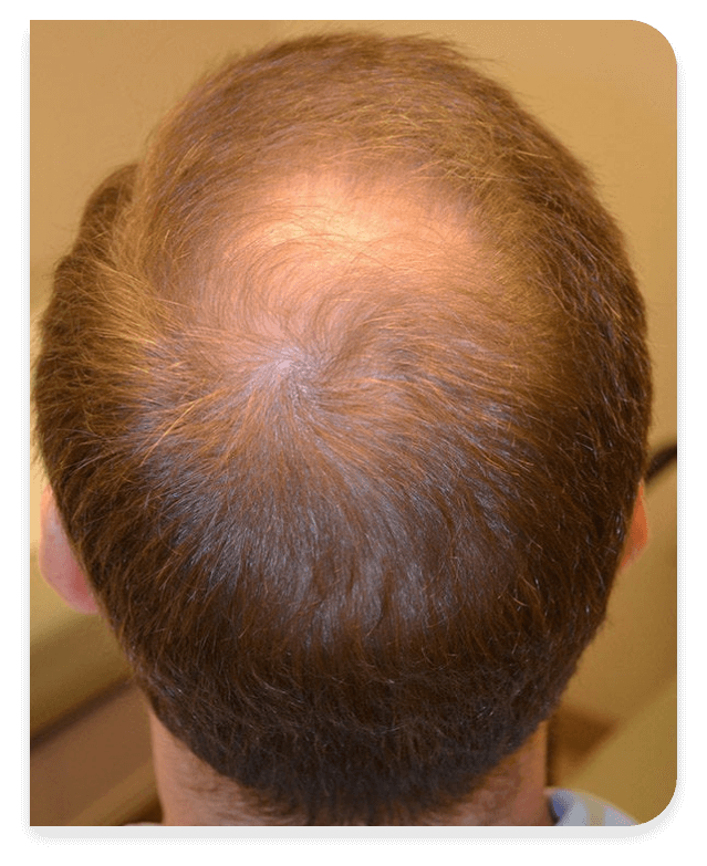 HairBeforeAR